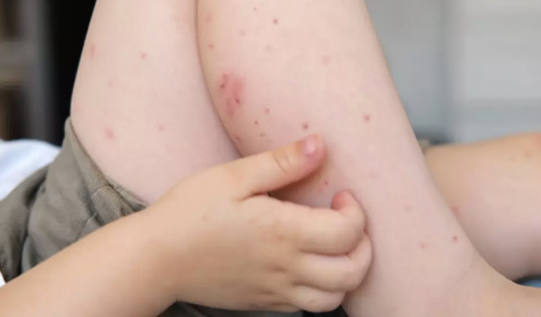 Autoridades sanitarias activan protocolos en Puebla tras detectar caso de sarampión